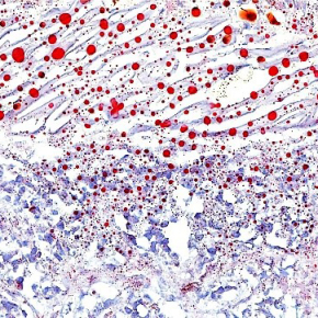 Cancer du cerveau : comment le cholestérol inonde les cellules souches du glioblastome